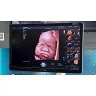 SonoScape P80 Elite-Ultraschallsystem