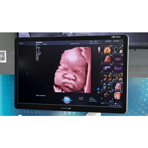 SonoScape P80 Elite Ultrasound System