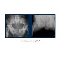 Arrow® T-POD™ Pelvic Stabilization Device