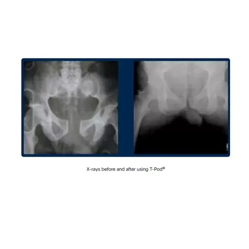 Arrow® T-POD™ Pelvic Stabilization Device