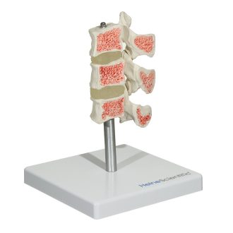 Osteoporosis Model
