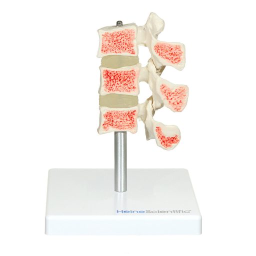 Osteoporosis Model