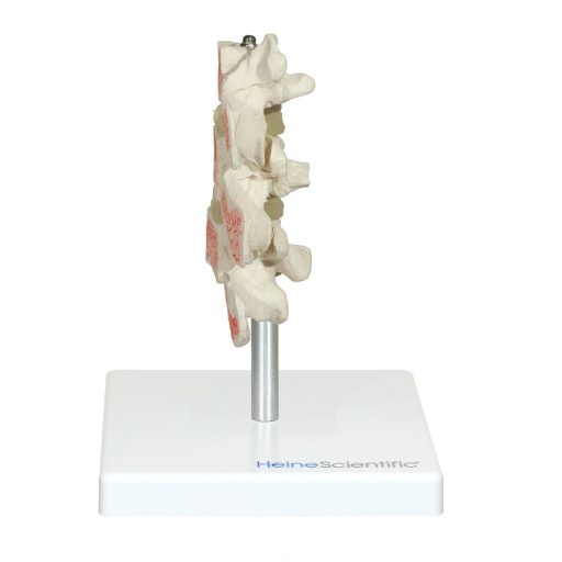 Osteoporosis Model