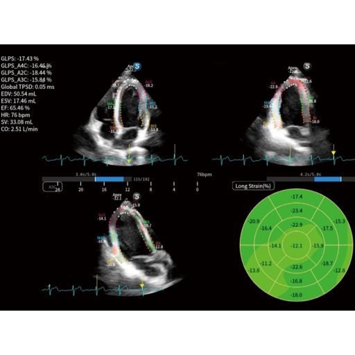 SonoScape X11 portable ultrasound device