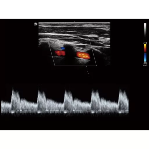 SonoScape X11 portable ultrasound device