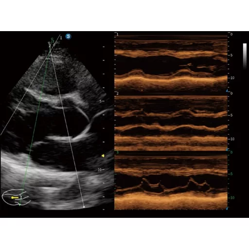 SonoScape X11 portable ultrasound device