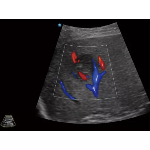 SonoScape X11 portable ultrasound device