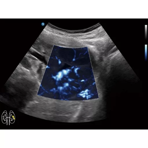 SonoScape X11 portable ultrasound device