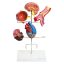 Hypertension model