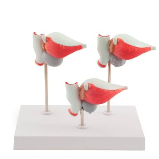 3 - częściowy model choroby prostaty
