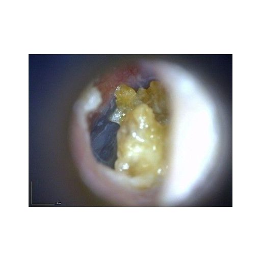 Digital-Otoskop EarScope Pro MEDL4E
