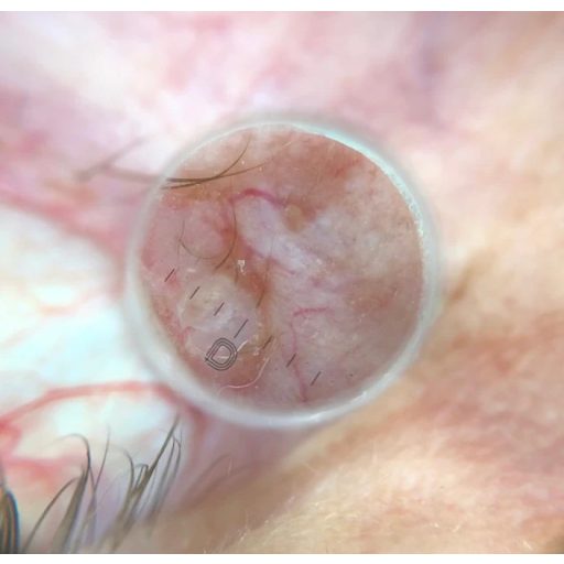 DermLite DL5 Small Contact Plate