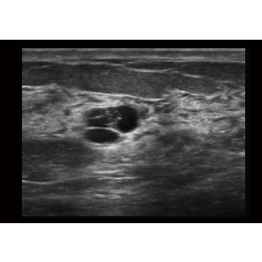 Sonoscape E2 Ultraschallsystem mit konvexer und linearer Sondev