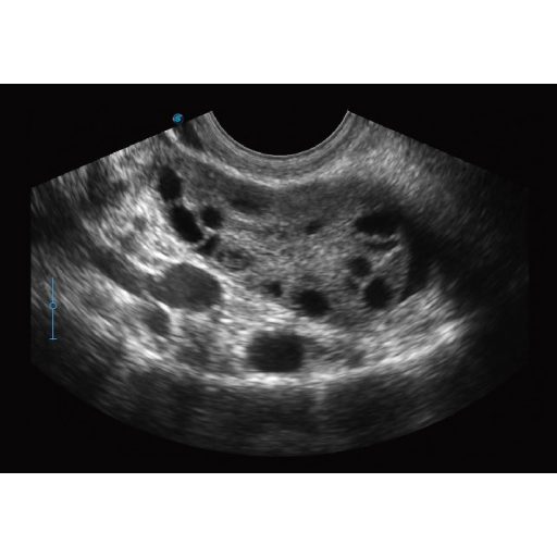 Sonoscape E2 Ultraschallsystem mit konvexer und linearer Sondev