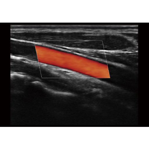 Sonoscape E2 Ultraschallsystem mit konvexer und linearer Sondev