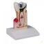 Dental caries model 10x