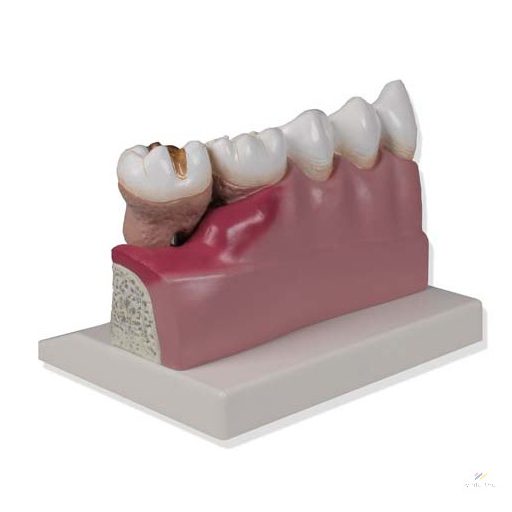 Dental model 4x