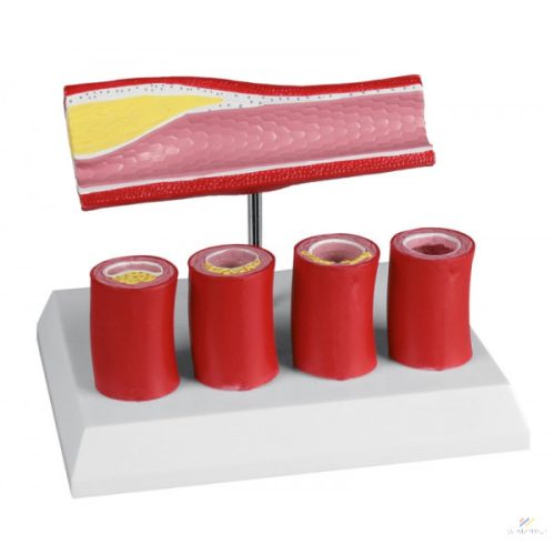 Artery model with 4 arterial stents