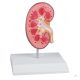 Kidney stone model