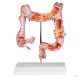 Colon model with diseases