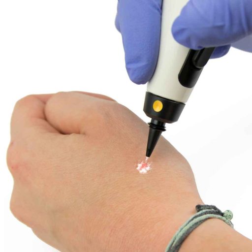 CryoPen X+ Gefrierstift