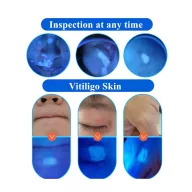 Woods Lamp for skin analysis Ultraviolet, Vitiligo UV lamp