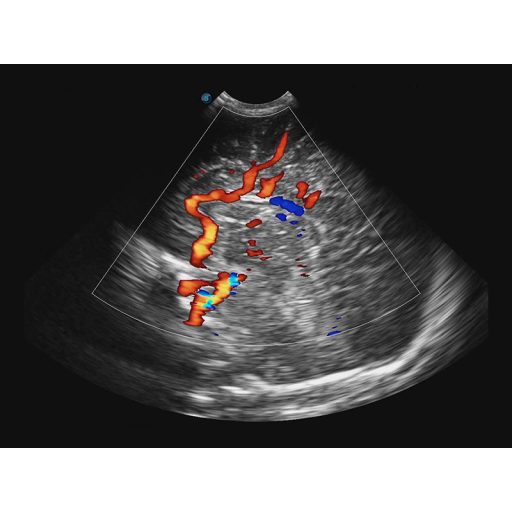 SonoScape E3 portable ultrasound